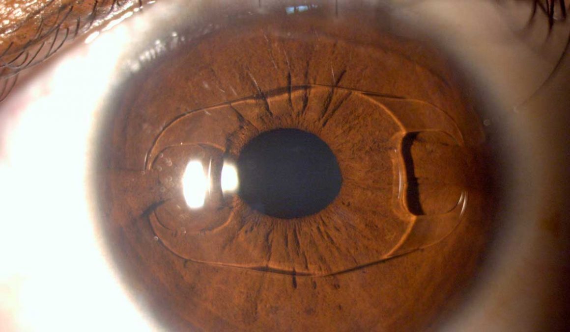 Calculation of intraocular lens power