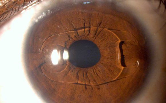 Calculation of intraocular lens power