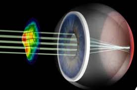 Cálculo de poder de lente intraocular