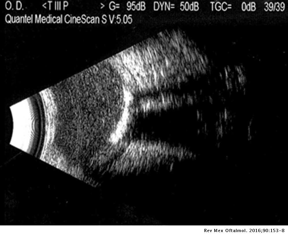 Examen ocular por ultrasonido