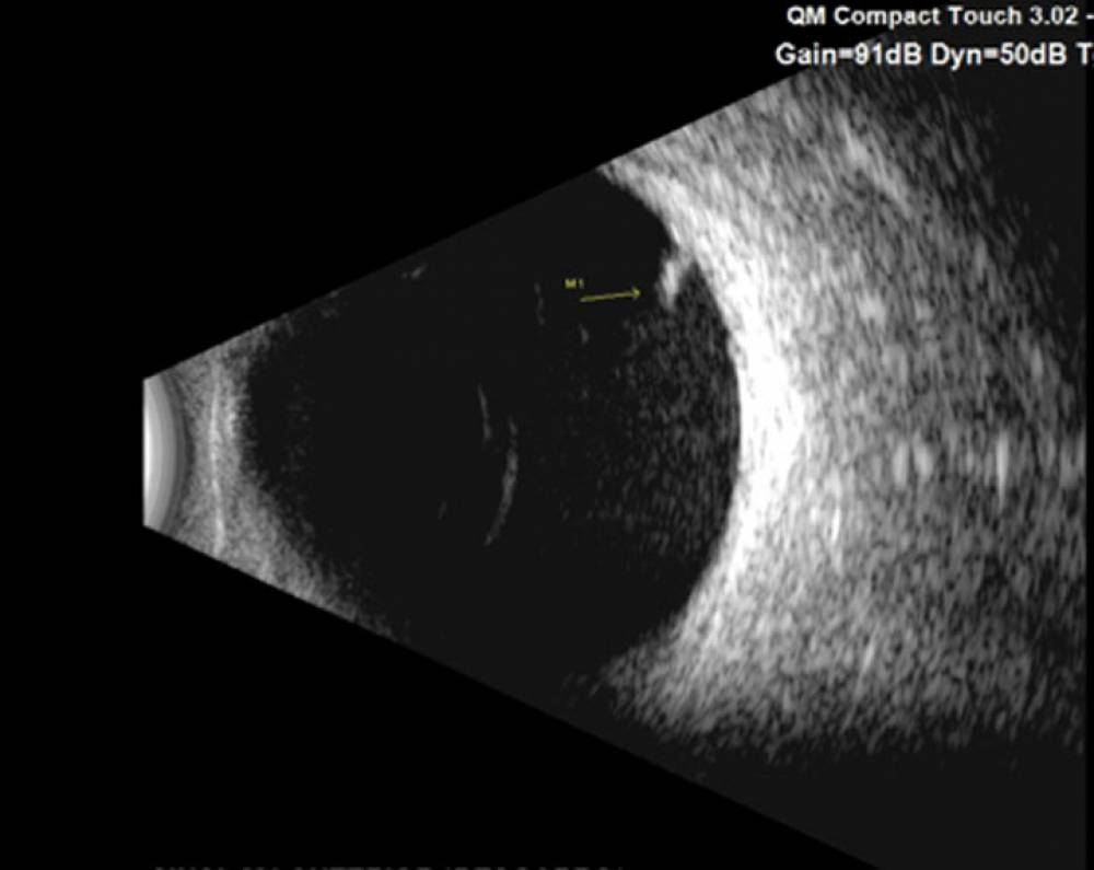 Examen ocular por ultrasonido